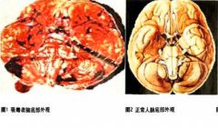 长期吸食冰毒的大脑解剖图